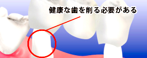 ブリッジの装着図 健康な両側の歯を削って装着している場合