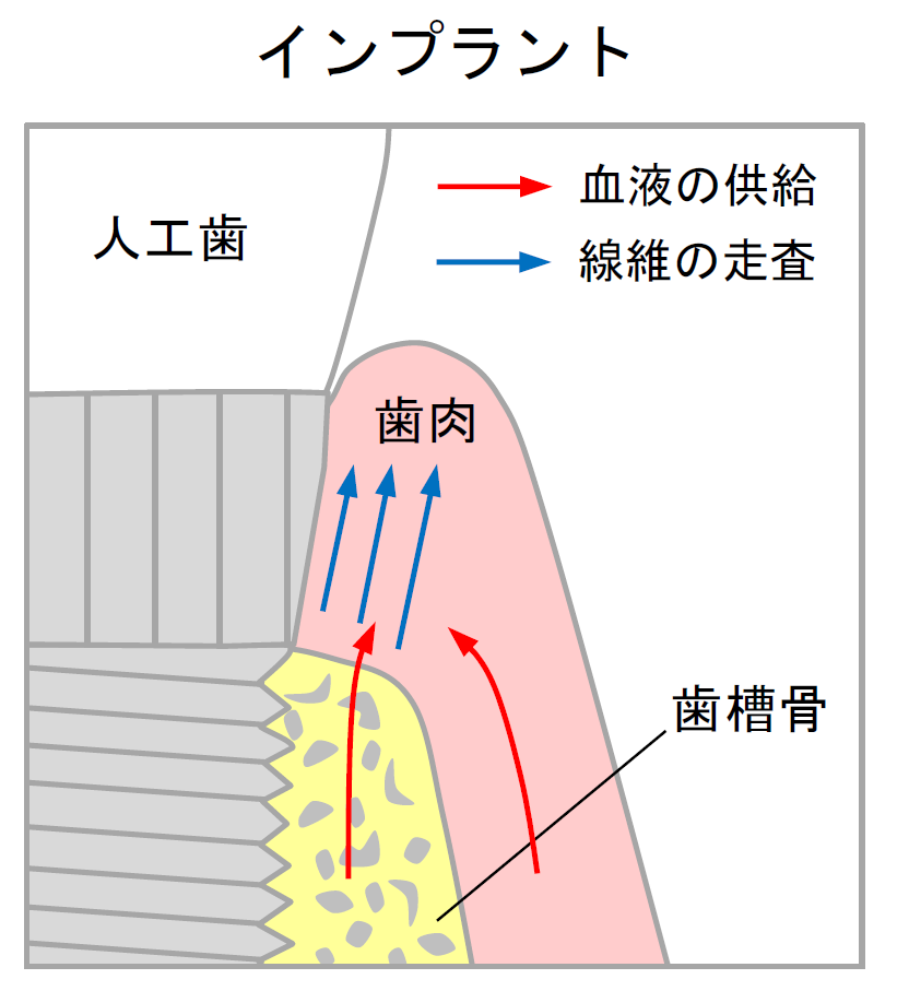 インプラントと歯肉、歯槽骨の関係図