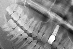 前歯部分にインプラントが埋入されているレントゲン写真