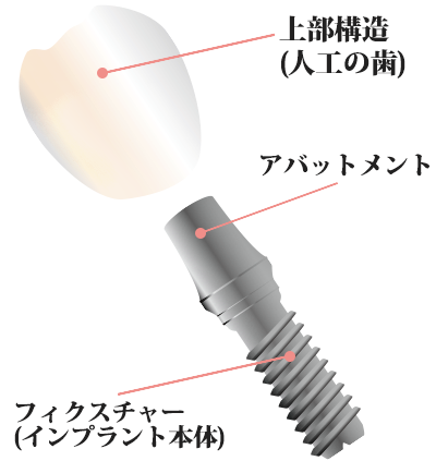 インプラントの構造 インプラントの構造