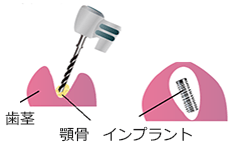 歯槽骨にドリルで穴を開け、インプラントを埋入します