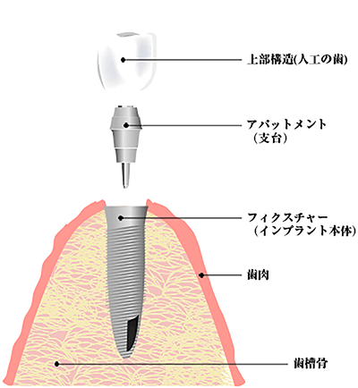 インプラントの構造